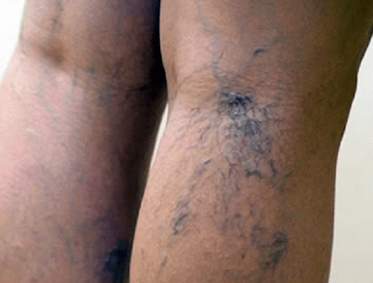 varices dans les jambes