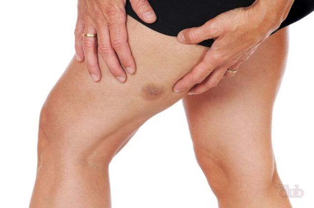 si une veine éclate