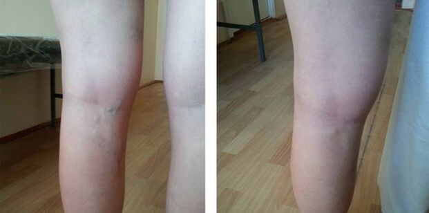 varices sur les jambes
