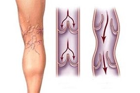 écoulement de sang dans les varices à différents stades de développement de la maladie