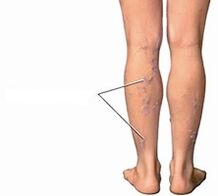 varices dans les jambes